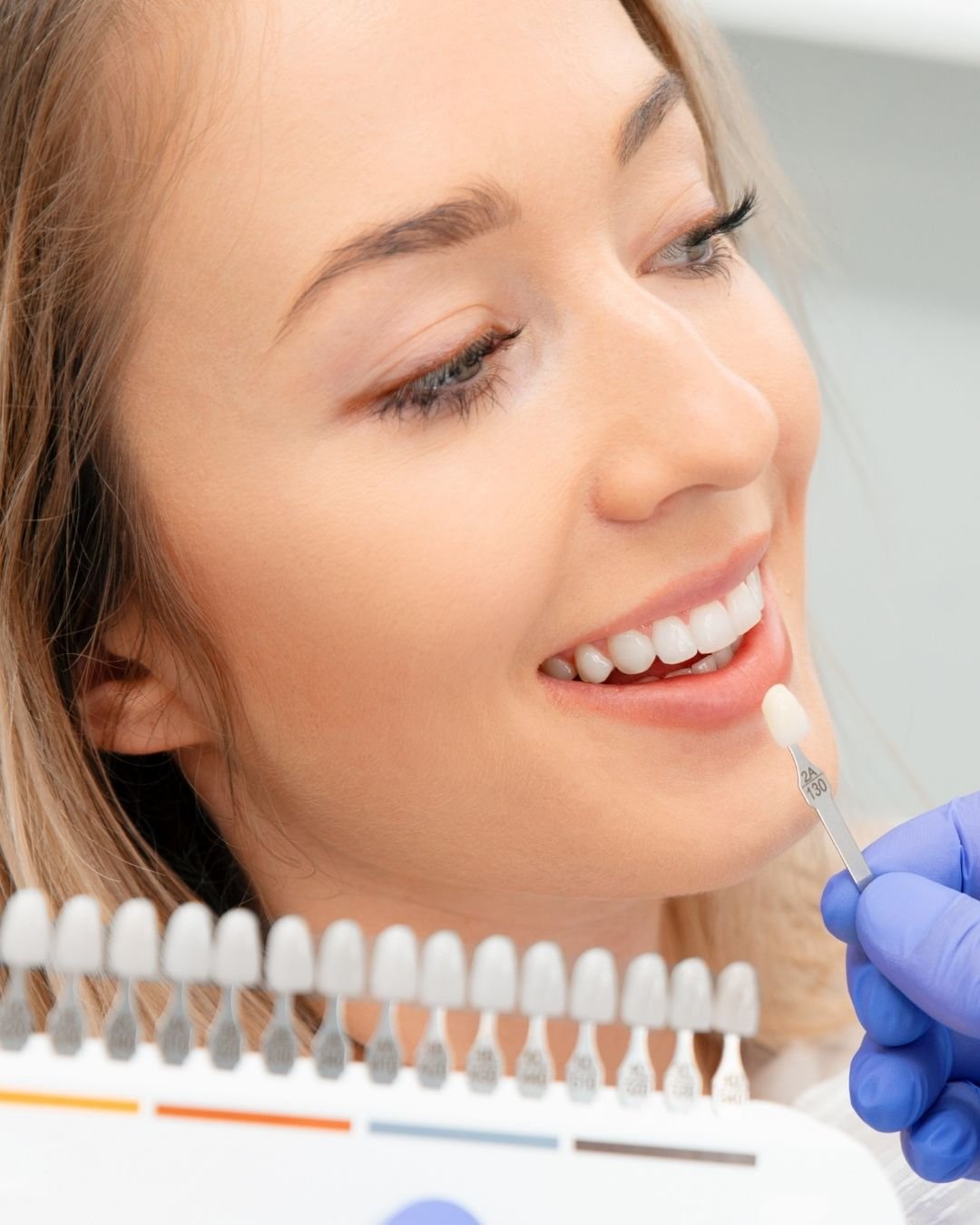 e.Max Veneers
